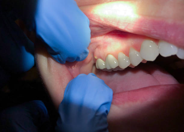 Best Walk-In Emergency Dentist in Aust, IN